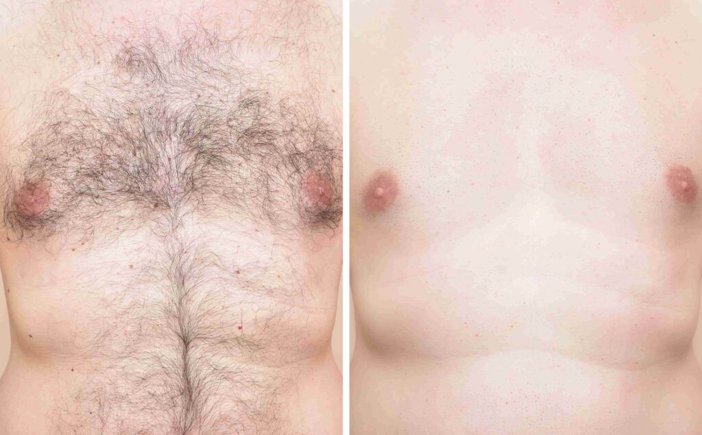 Before and after results of laser hair removal in Houston, TX.